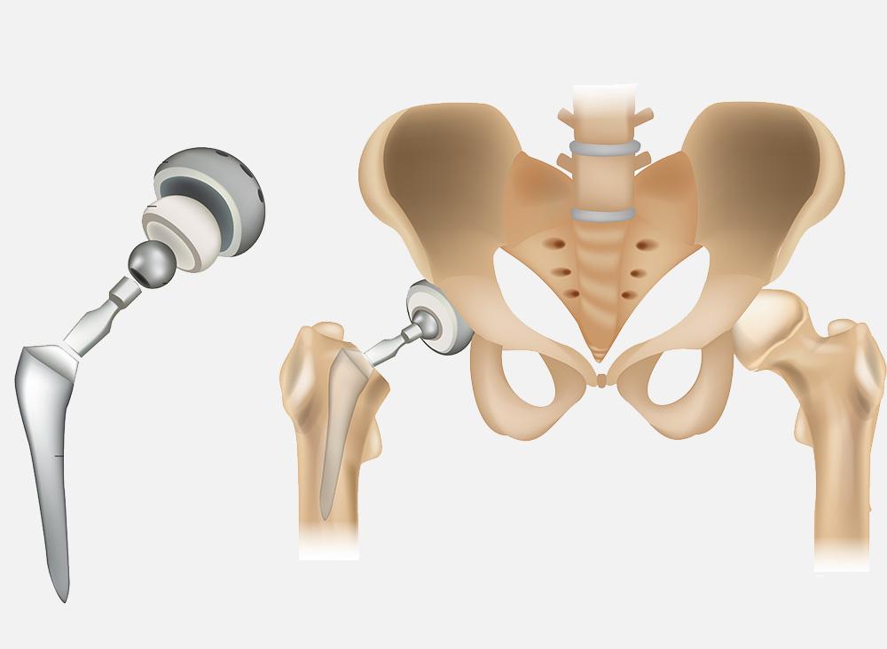 Prothèse totale hanche